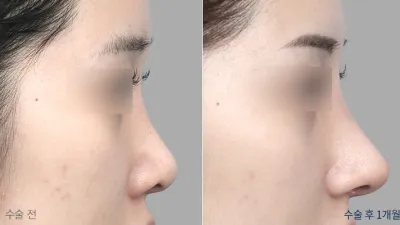 Before & After