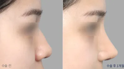 Before & After