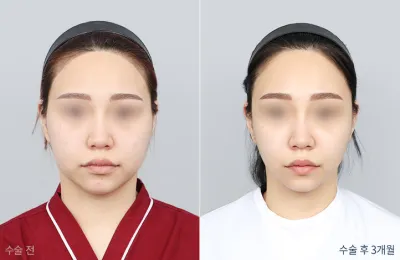 Before & After