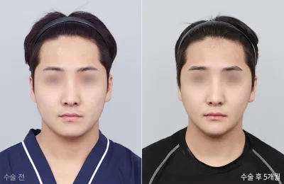 Before & After