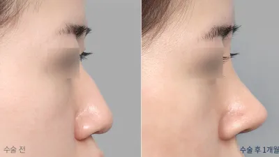 Before & After