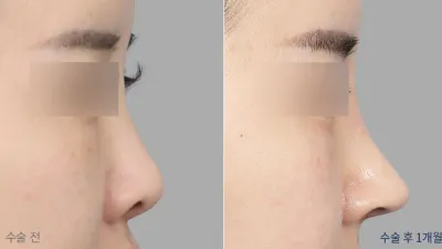 Before & After