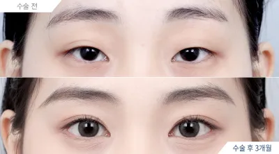 Before & After