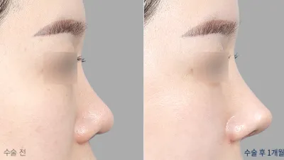 Before & After