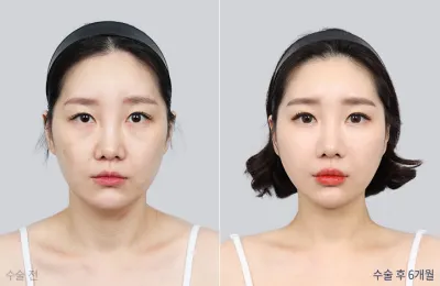 Before & After