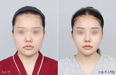 Before & After
