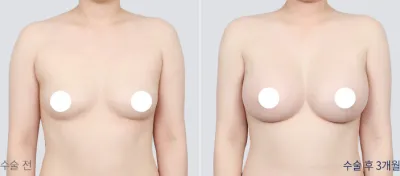 Before & After