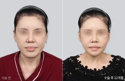 Before & After