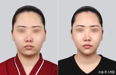 Before & After