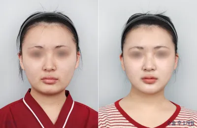 Before & After