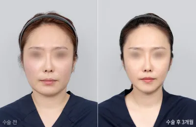 Before & After