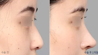 Before & After