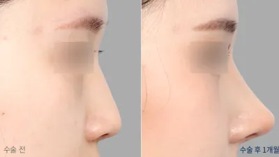 Before & After