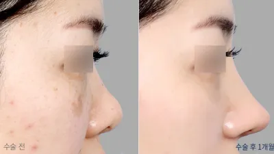 Before & After