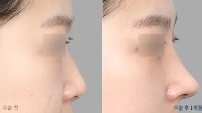 Before & After