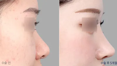 Before & After