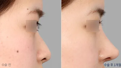 Before & After