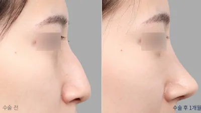 Before & After
