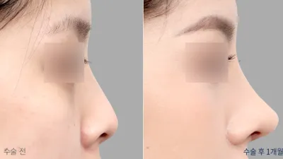 Before & After