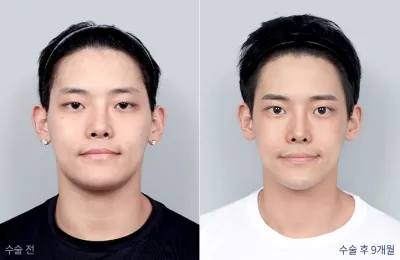 Before & After