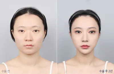 Before & After