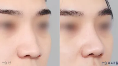 Before & After