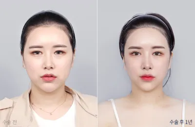 Before & After