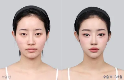 Before & After