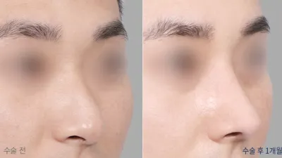 Before & After