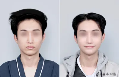 Before & After