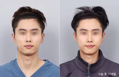 Before & After