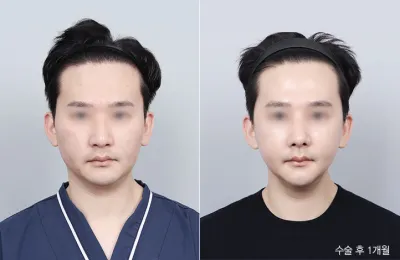 Before & After