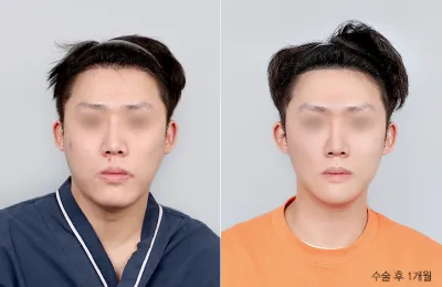 Before & After