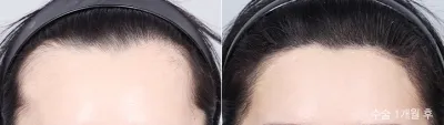 Before & After