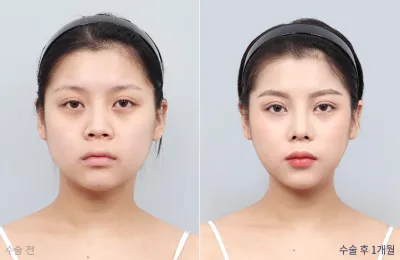 Before & After