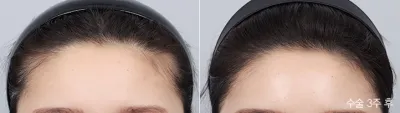 Before & After