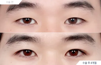 Before & After
