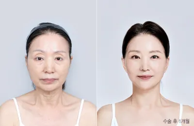 Before & After