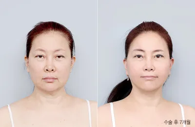 Before & After