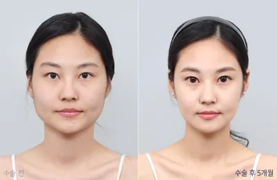 Before & After