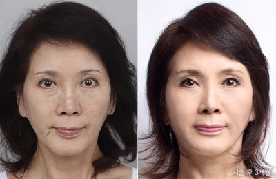 Before & After