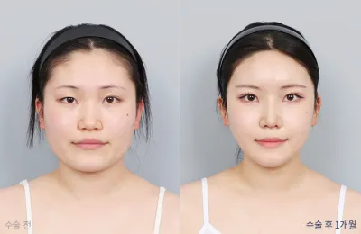 Before & After