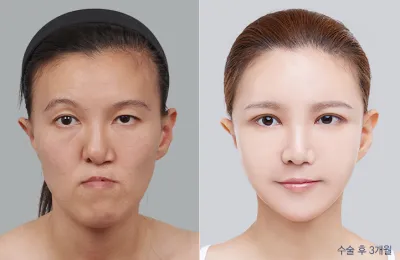 Before & After