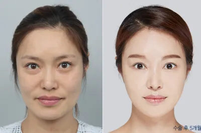 Before & After