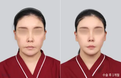 Before & After