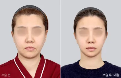 Before & After