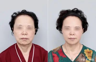 Before & After