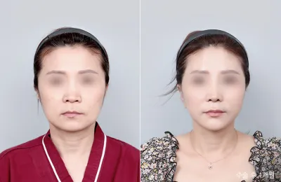 Before & After