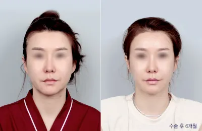 Before & After