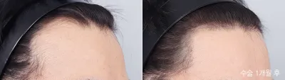Before & After